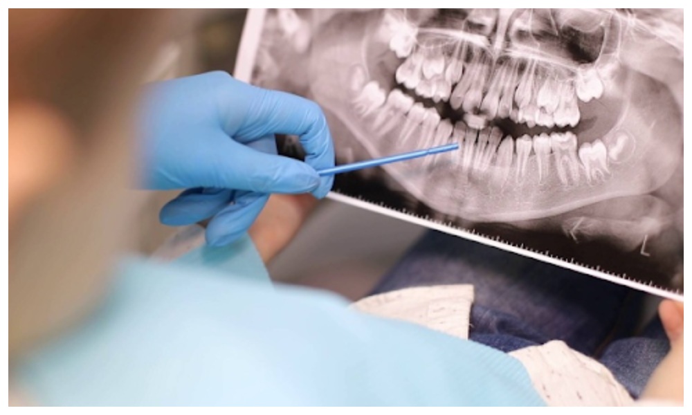 Nha Khoa Quốc Tế Sài Gòn Chụp CT trước khi trồng implant để đánh giá tình trạng răng miệng
