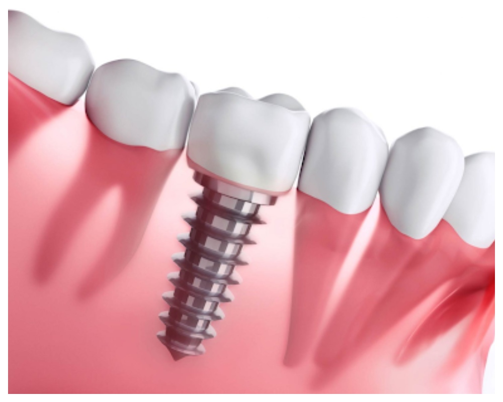 Nha Khoa Quốc Tế Sài Gòn Rặng tạm được sử dụng trong thời gian chờ trụ Implant tích hợp với xương