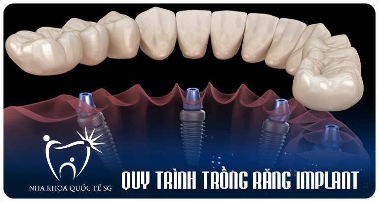 Nha Khoa Quốc Tế Sài Gòn quy trinh trong rang implant