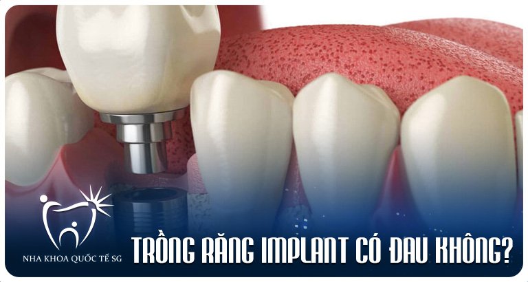 Nha Khoa Quốc Tế Sài Gòn trong rang implant co dau khong 1