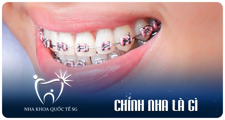 Nha Khoa Quốc Tế Sài Gòn chinh nha la gi