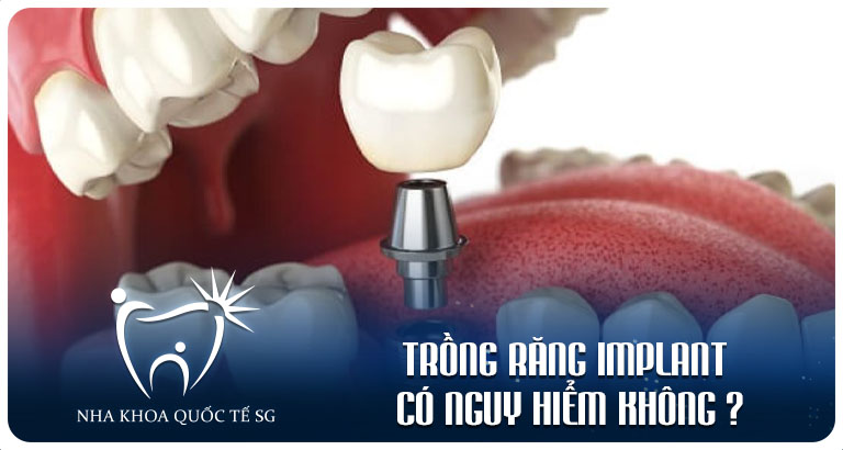 Nha Khoa Quốc Tế Sài Gòn trong rang implant co nguy hiem khong
