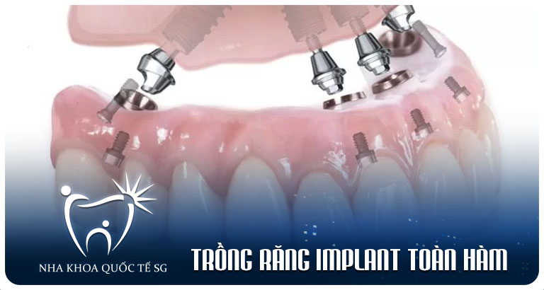 Nha Khoa Quốc Tế Sài Gòn trong rang implant toan ham