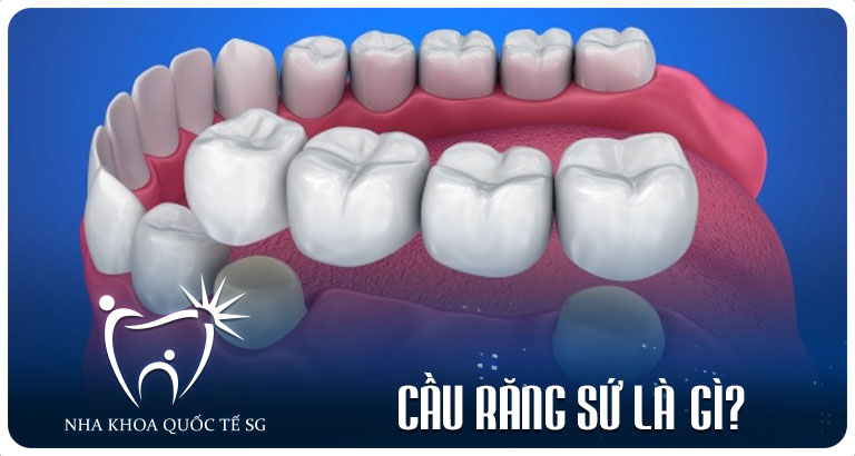 Nha Khoa Quốc Tế Sài Gòn cau rang su la gi 1