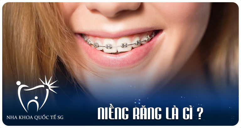 Niềng răng là gì