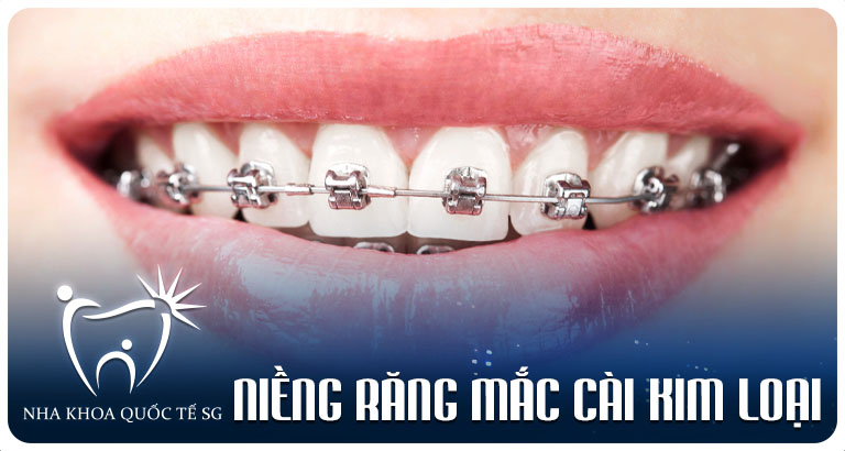 Nha Khoa Quốc Tế Sài Gòn nieng rang mac cai kim loai 1