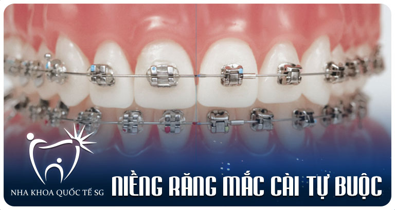 Nha Khoa Quốc Tế Sài Gòn nieng rang mac cai tu buoc 1