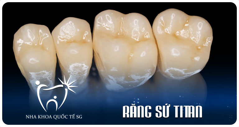 Nha Khoa Quốc Tế Sài Gòn Nha Khoa Quốc Tế Sài Gòn rang su titan