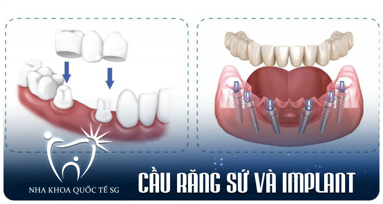 Nha Khoa Quốc Tế Sài Gòn Cau rang su va Implant