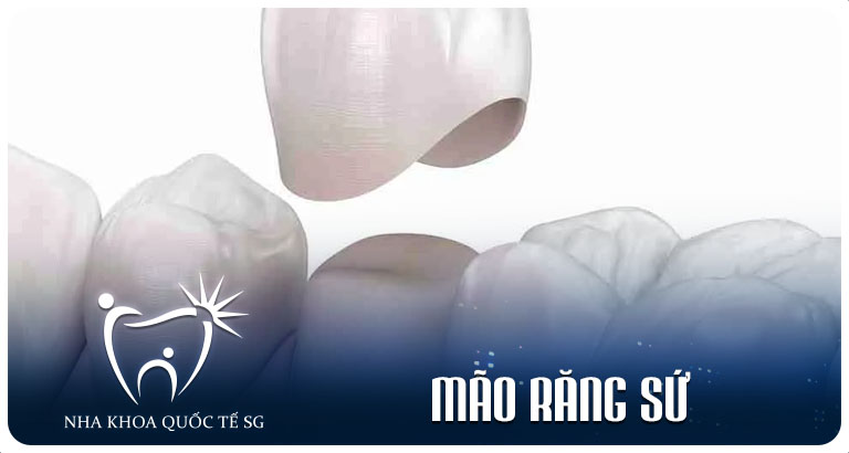 Nha Khoa Quốc Tế Sài Gòn Mao rang su