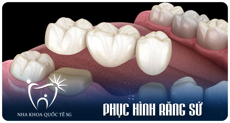 Nha Khoa Quốc Tế Sài Gòn Phuc hinh rang su