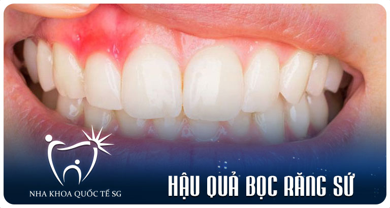 Nha Khoa Quốc Tế Sài Gòn hau qua boc rang su