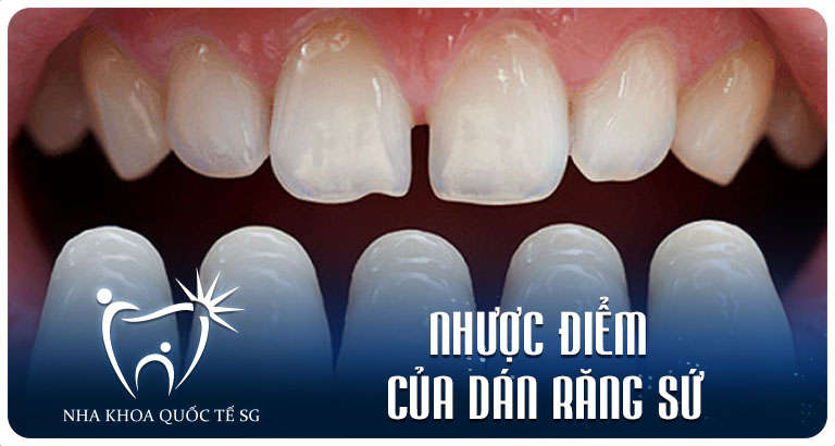 Nha Khoa Quốc Tế Sài Gòn nhuoc diem cua dan rang su 1