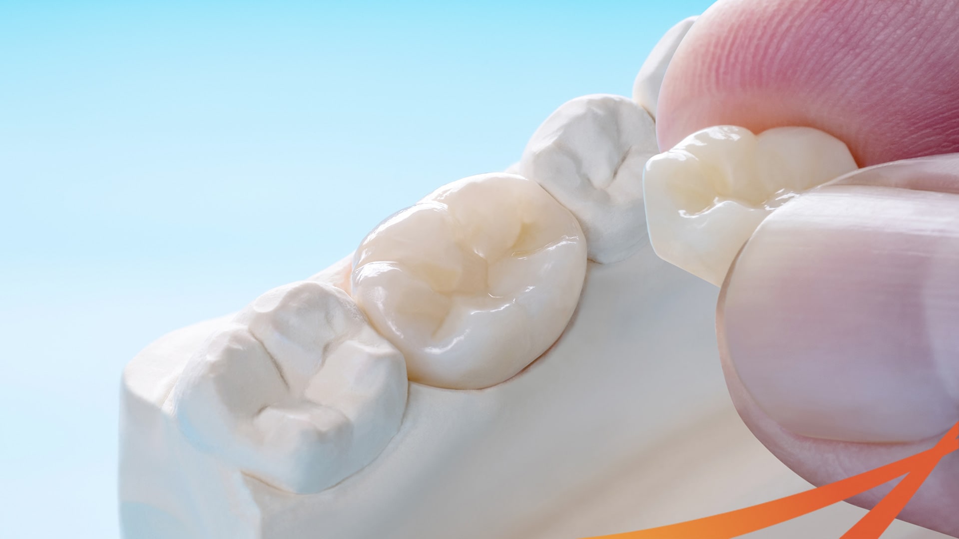 Nha Khoa Quốc Tế Sài Gòn Tìm hiểu về mão răng sứ