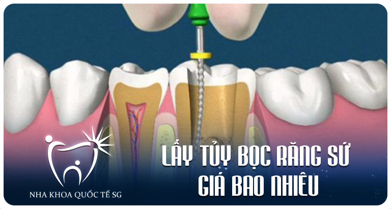Nha Khoa Quốc Tế Sài Gòn Nha Khoa Quốc Tế Sài Gòn Lay tuy boc rang su gia bao nhieu