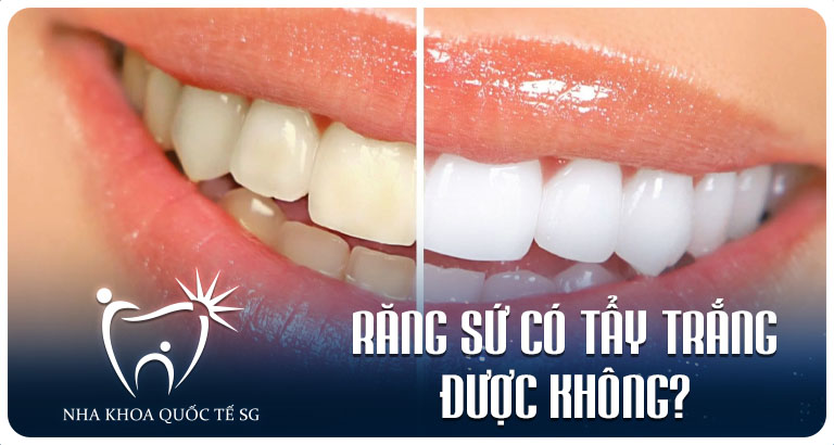 Nha Khoa Quốc Tế Sài Gòn Nha Khoa Quốc Tế Sài Gòn Rang su co tay trang duoc khong