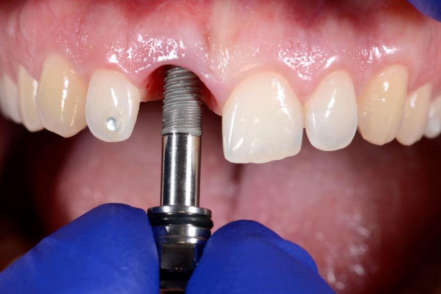 Nha Khoa Quốc Tế Sài Gòn Cam kết sử dụng các Implant chính hãng và tốt nhất hiện nay