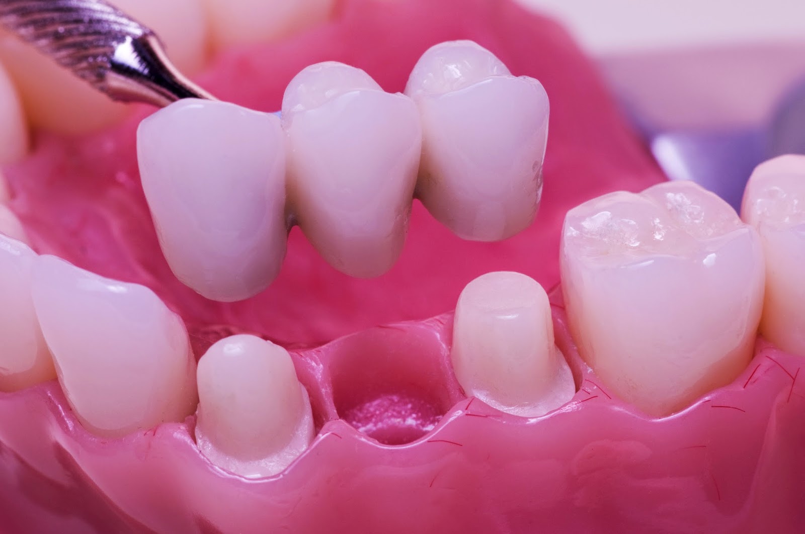 Yếu tố ảnh hưởng chi phí cầu răng sứ
