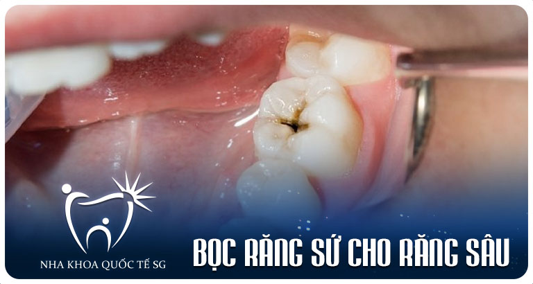 Nha Khoa Quốc Tế Sài Gòn Nha Khoa Quốc Tế Sài Gòn boc rang su cho rang sau
