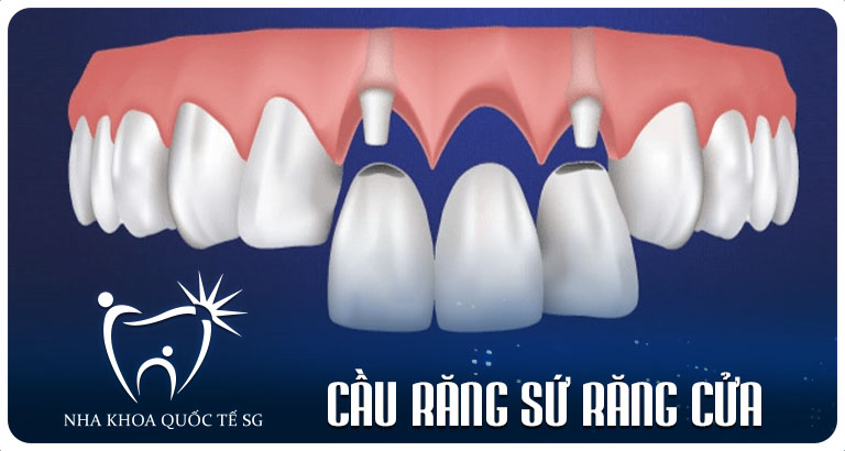 Nha Khoa Quốc Tế Sài Gòn Nha Khoa Quốc Tế Sài Gòn cau rang su rang cua