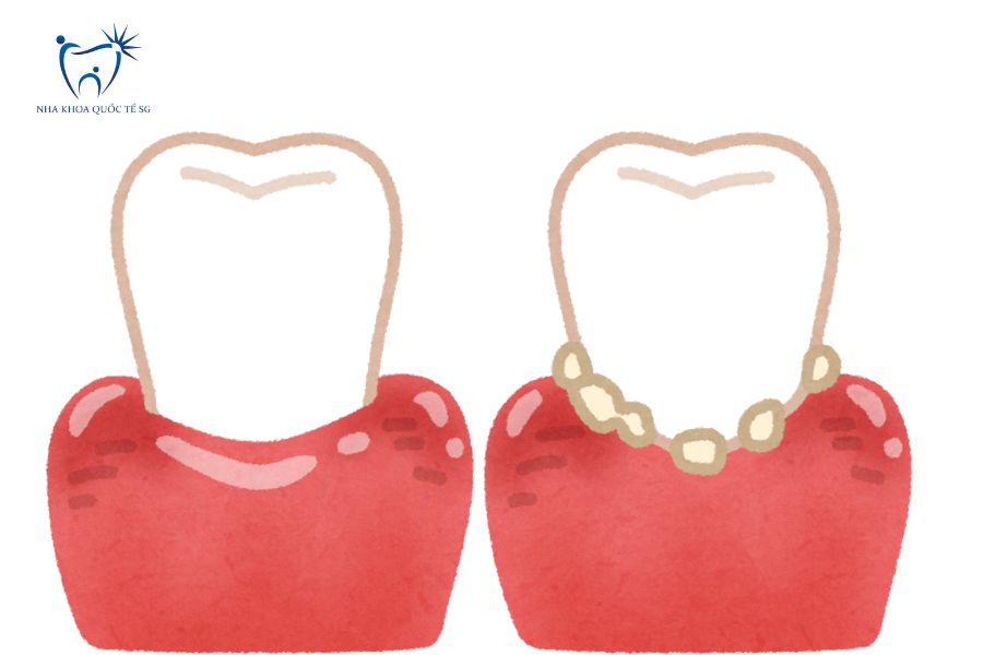 Nha Khoa Quốc Tế Sài Gòn Bọc răng sứ bị viêm mủ và sưng đỏ ở nướu