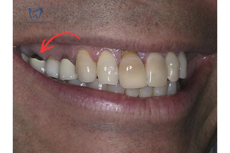 Nha Khoa Quốc Tế Sài Gòn Bệnh nhân bị hở đường hoàn tất khi bọc răng sứ kim loại