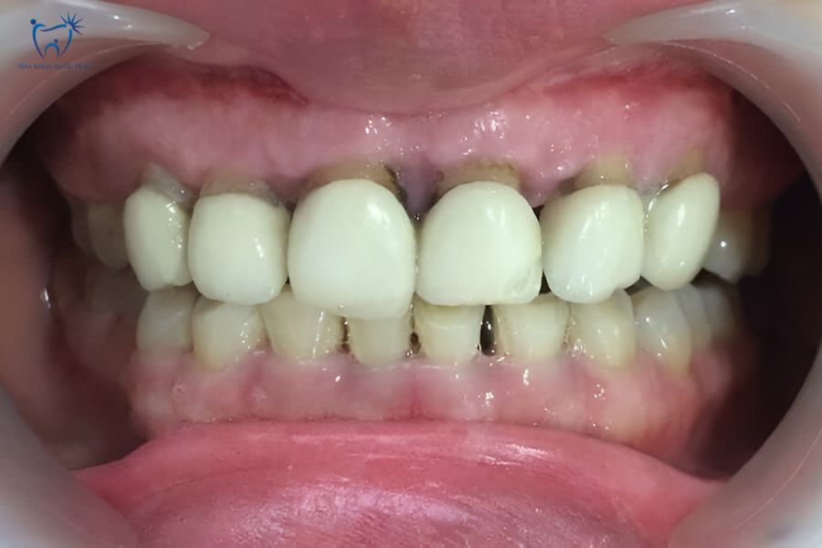 Nha Khoa Quốc Tế Sài Gòn Bọc răng sứ xong bị hở đường hoàn tất