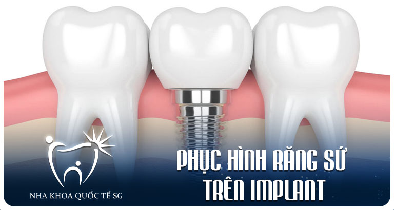 Phục hình răng sứ trên Implant