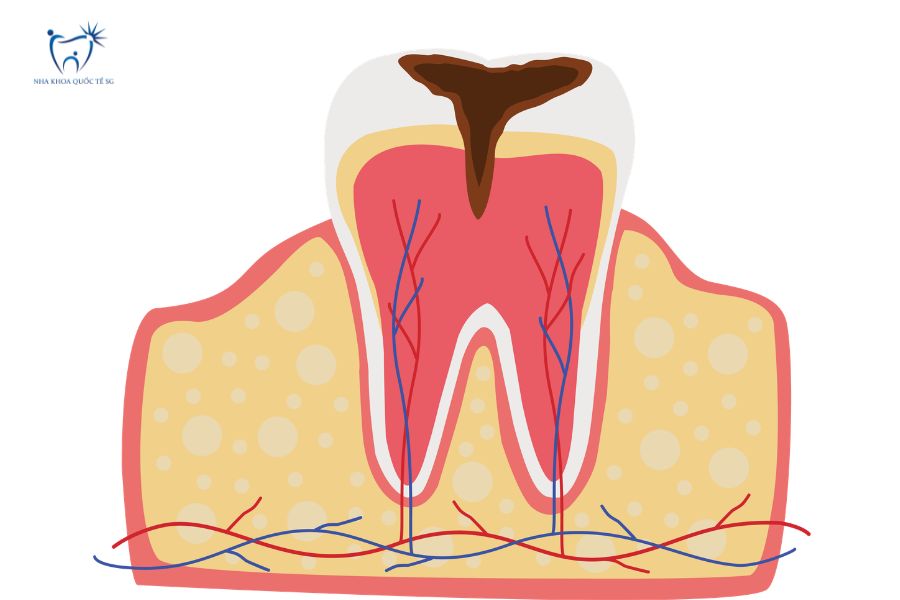 Nha Khoa Quốc Tế Sài Gòn Bọc răng sứ xong bị sâu răng