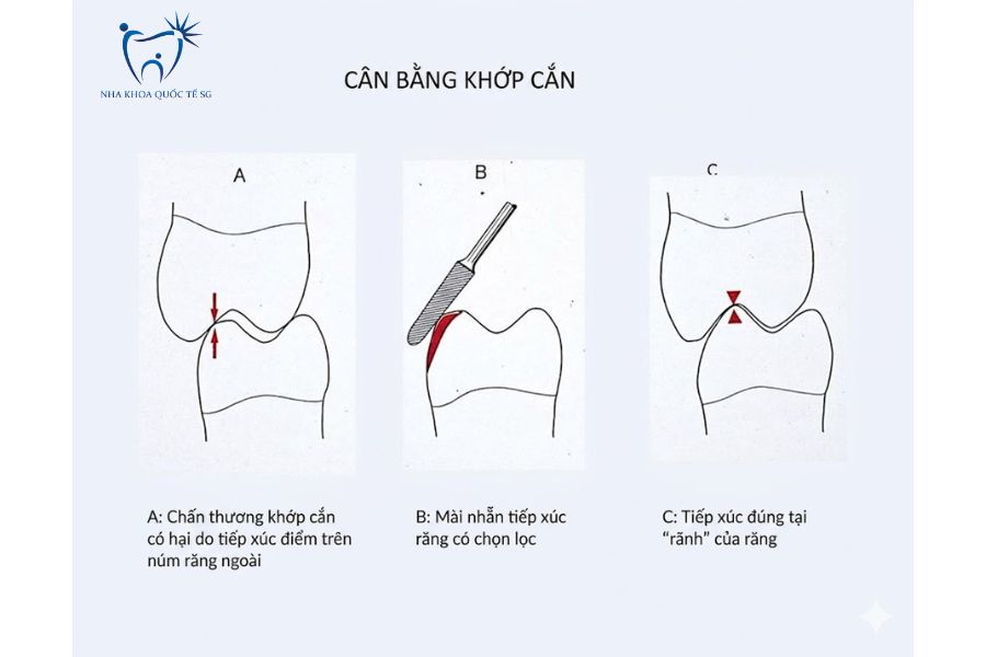 Tình trạng khớp cắn không cân bằng
