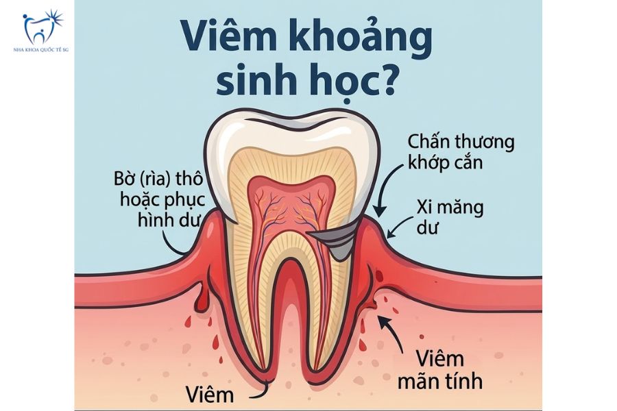Nha Khoa Quốc Tế Sài Gòn Bọc răng sứ vi phạm khoảng cách sinh học dẫn đến viêm