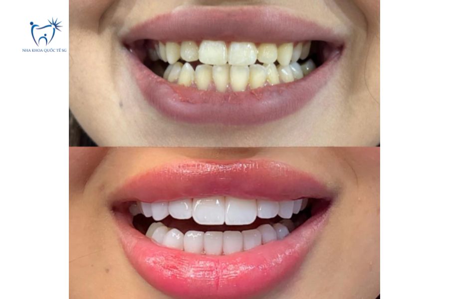 Bệnh nhân dán Veneer dáng răng thỏ sứ