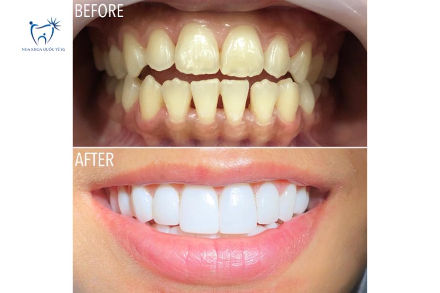 Bệnh nhân dán Veneer dáng răng thỏ sứ