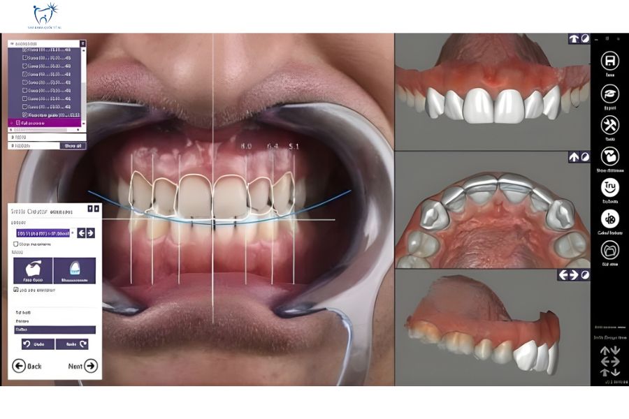 Công nghệ thiết kế nụ cười để phân tích tỷ lệ gương mặt