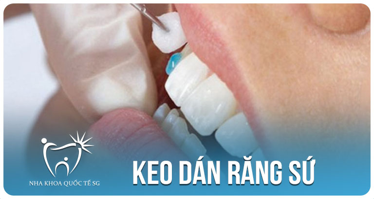 Nha Khoa Quốc Tế Sài Gòn keo dan rang su