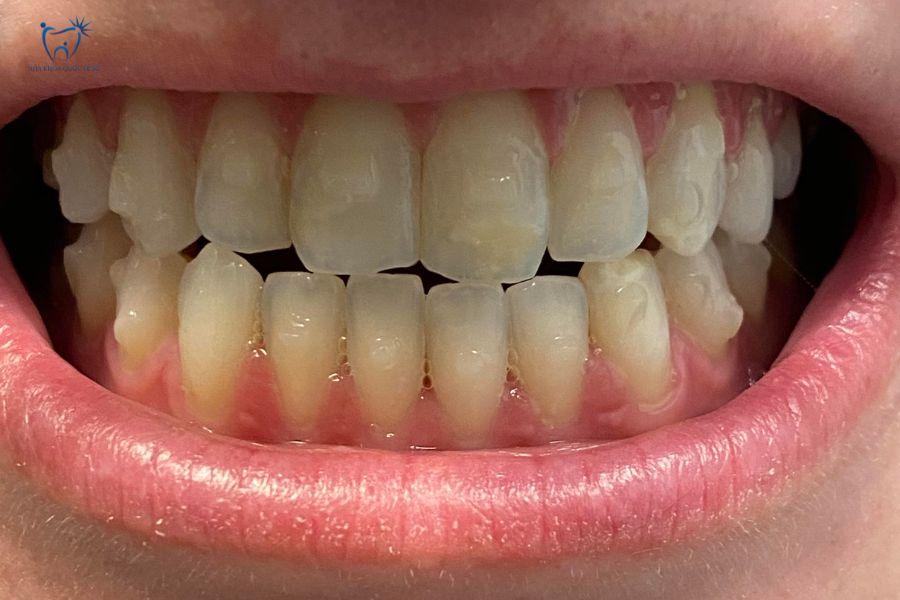 Hình ảnh thực tế bệnh nhân có khớp cắn đối