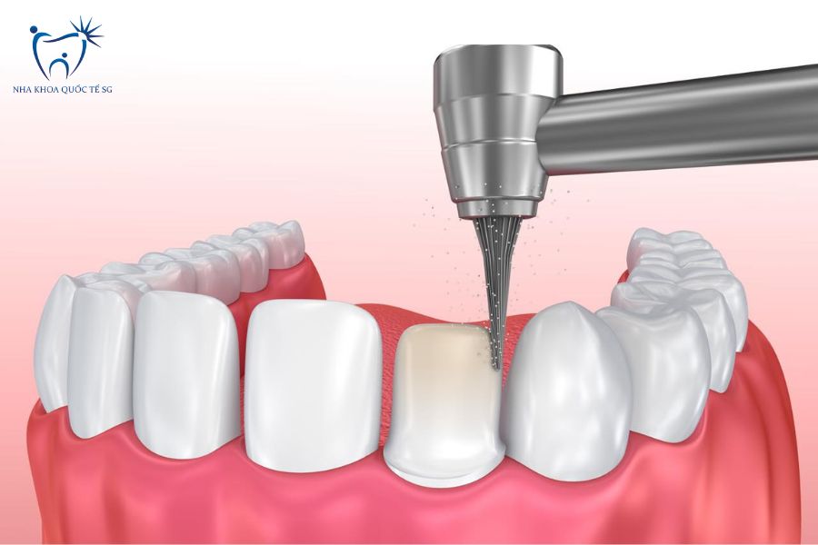 Nha Khoa Quốc Tế Sài Gòn Bác sĩ sử dụng dụng cụ chuyên dụng để mài nhỏ răng