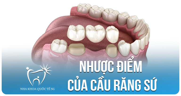 Nha Khoa Quốc Tế Sài Gòn nhuoc diem cau rang su
