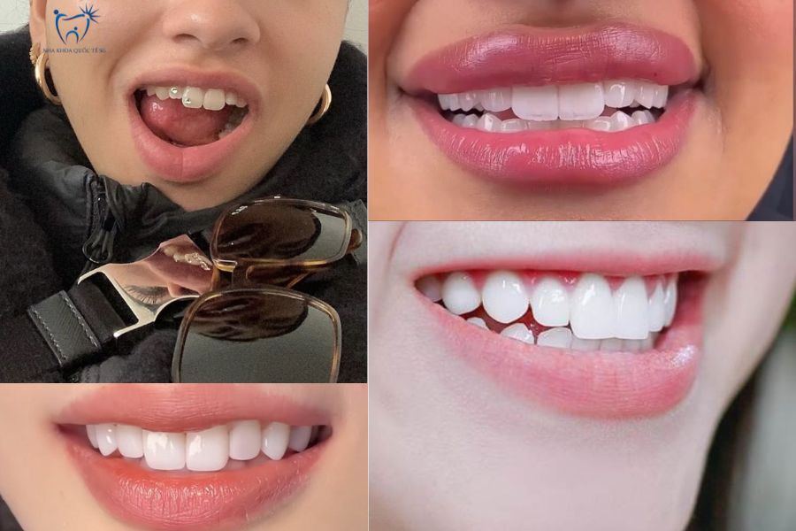 Hình ảnh mẫu về dáng răng thỏ sứ