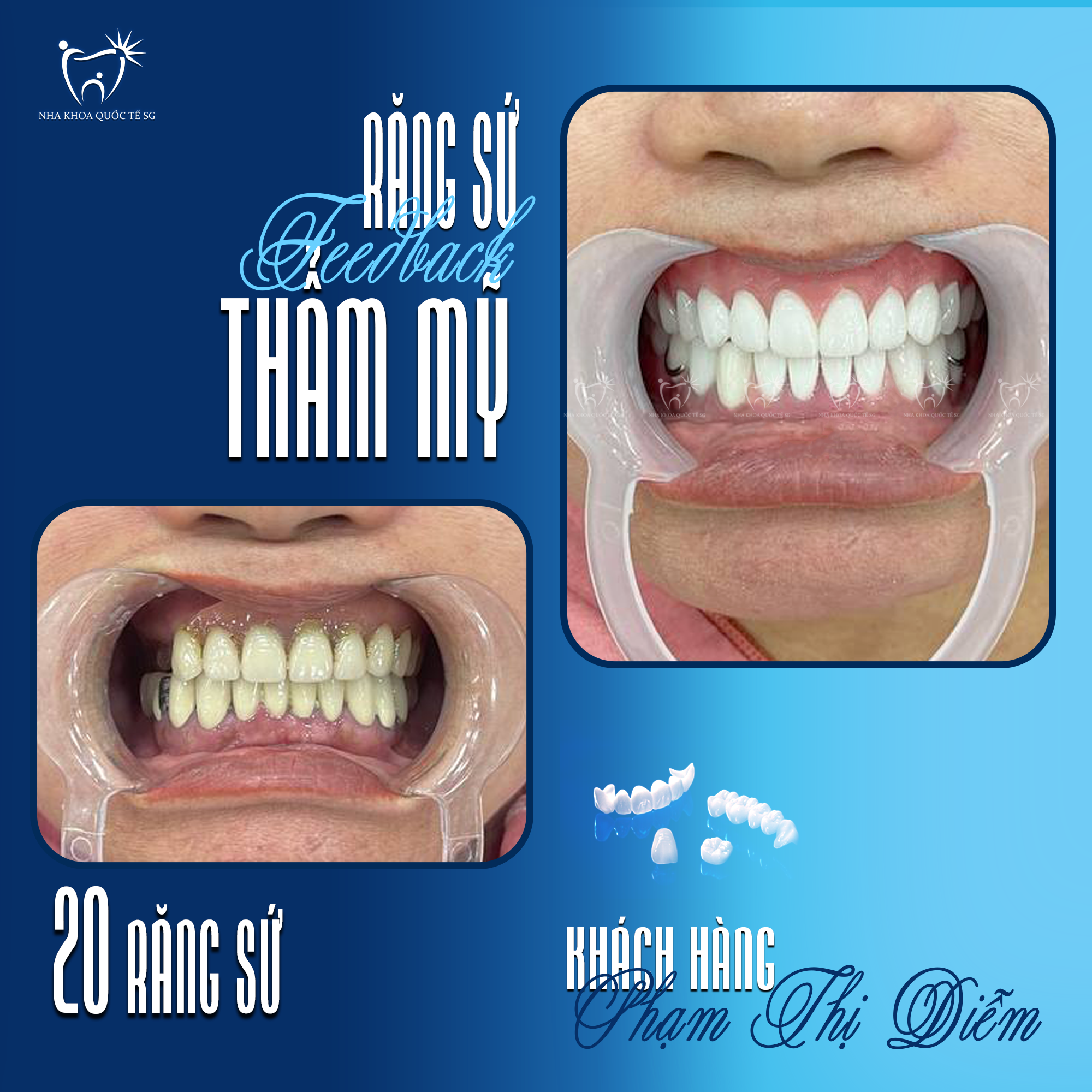 Khách Hàng Phạm Thị Diễm bọc 20 răng sứ