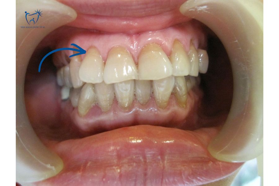 Vùng cổ chân răng là nơi dễ gây ê buốt răng