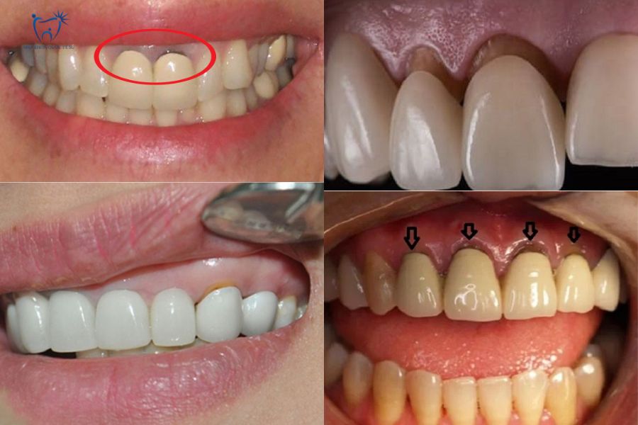 Mão răng sứ không khít khiến răng bị đen viền