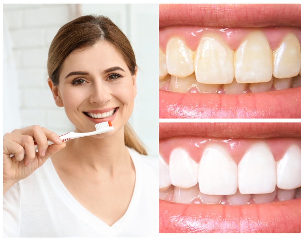 Nha Khoa Quốc Tế Sài Gòn Nguyên nhân tẩy trắng răng bị vàng lại