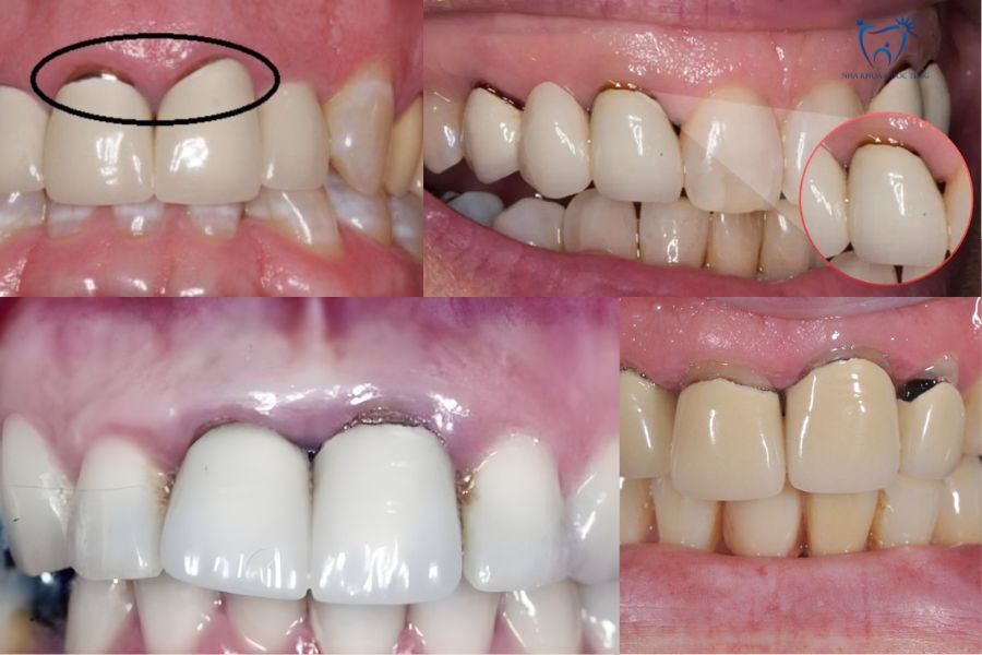 Hình ảnh bệnh nhân bọc răng sứ bị đen chân răng
