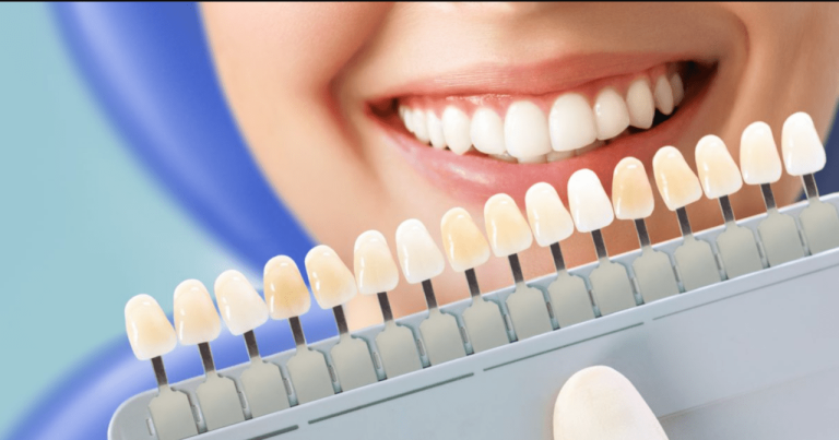 Tẩy trắng răng uy tín tại Nha khoa Quốc Tế SG