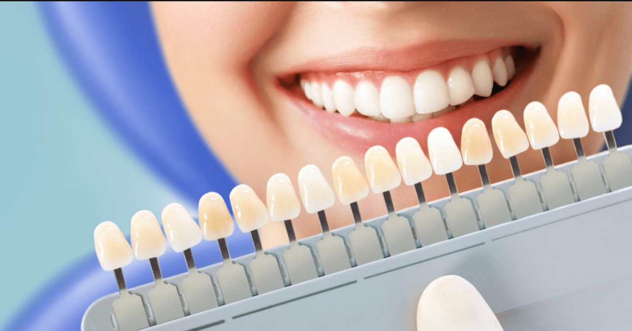 Nha Khoa Quốc Tế Sài Gòn Tẩy trắng răng uy tín tại Nha khoa Quốc Tế SG