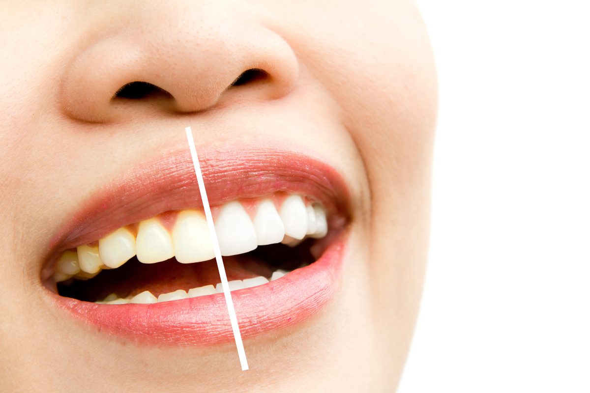Nha Khoa Quốc Tế Sài Gòn Tẩy trắng răng xong bị vàng lại