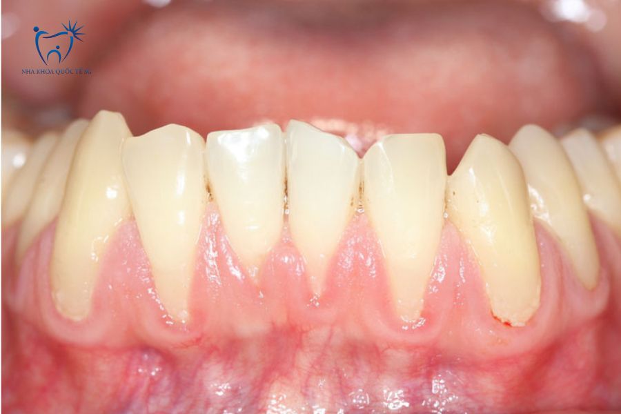 Tụt nướu là nguyên nhân bị đen viền nướu