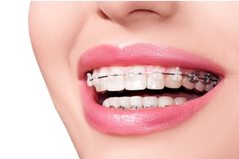 Nha Khoa Quốc Tế Sài Gòn Bọc răng sứ có niềng răng được không