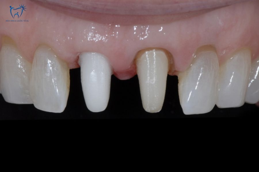 Cùi răng bị mài nhỏ dẫn đến răng thật không còn chắc khỏe